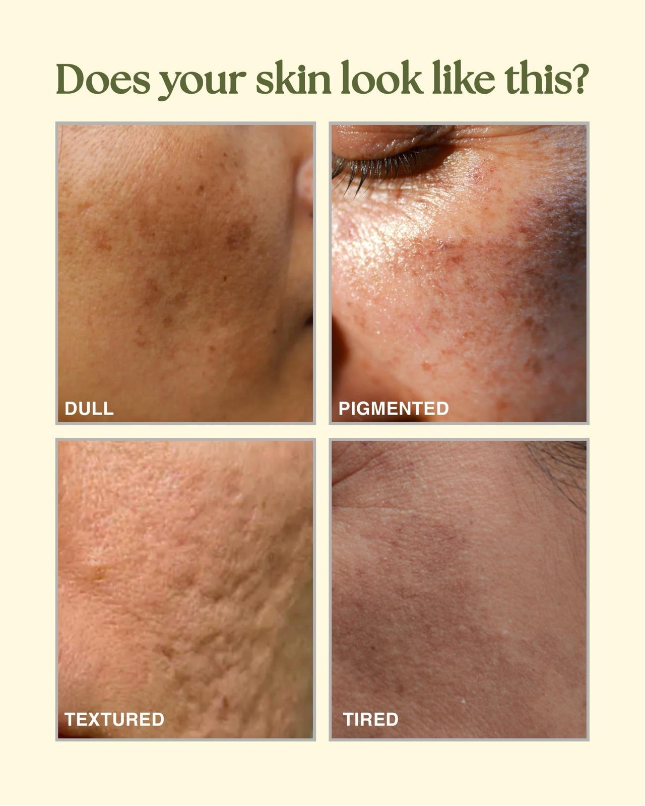 Does your skin look like this? Dull, pigmented, textured and tired skin